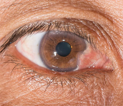 Keratoconus Treatment Bayside