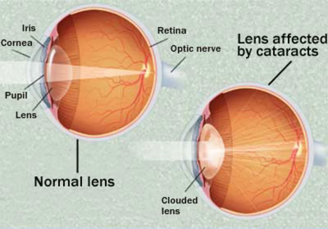Cataracts Eye Specialist 11361