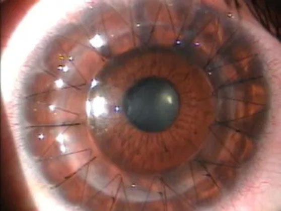 Keratoconus Treatment Bayside