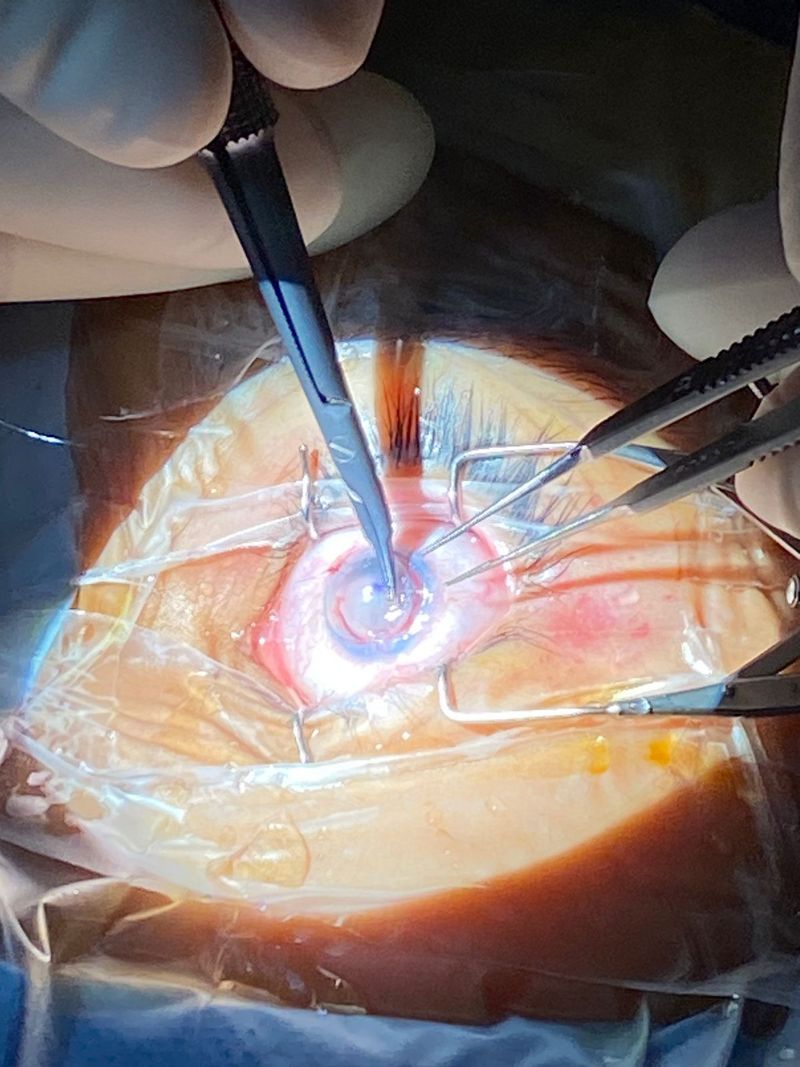 New York Cornea Consultants | Botox Restylane, Diabetic Retinopathy and Cornea Transplant Treatment