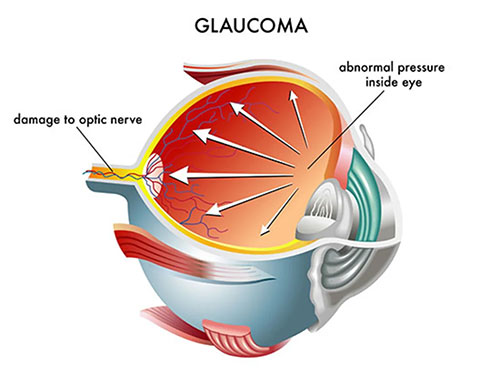Glaucoma Eye Care Bayside