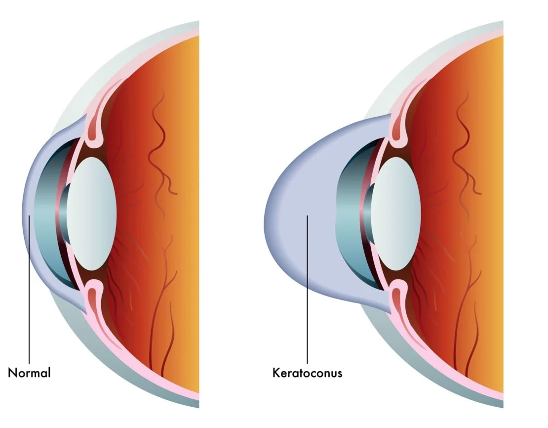 Keratoconus Treatment Bayside