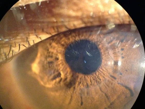 Cornea Transplant near Bayside