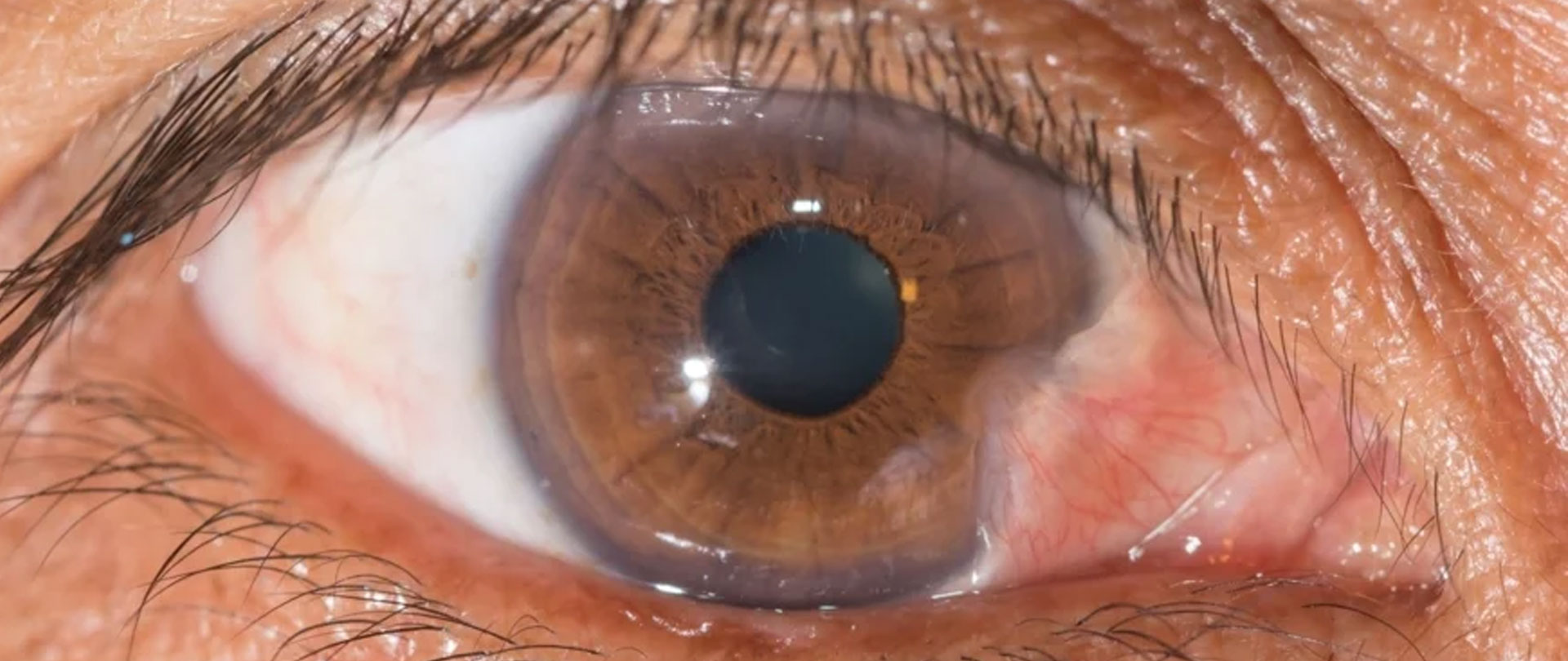 Cornea Transplant near Bayside